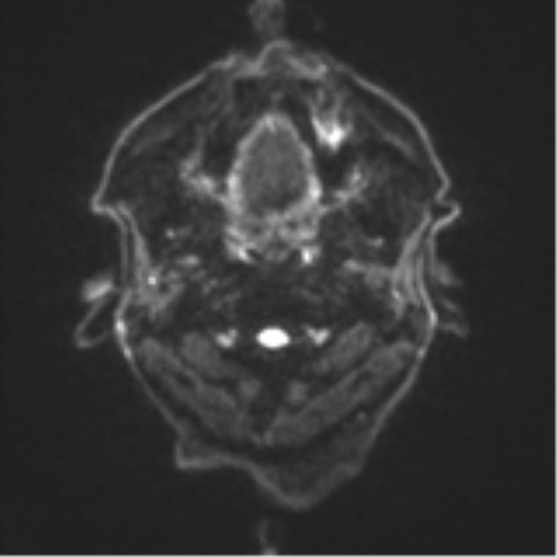 File:Cerebral toxoplasmosis (Radiopaedia 54575-60804 Axial DWI 34).png