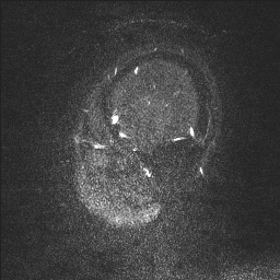 Cerebral tuberculosis with dural sinus invasion (Radiopaedia 60353-68090 Sagittal MRV 140).jpg