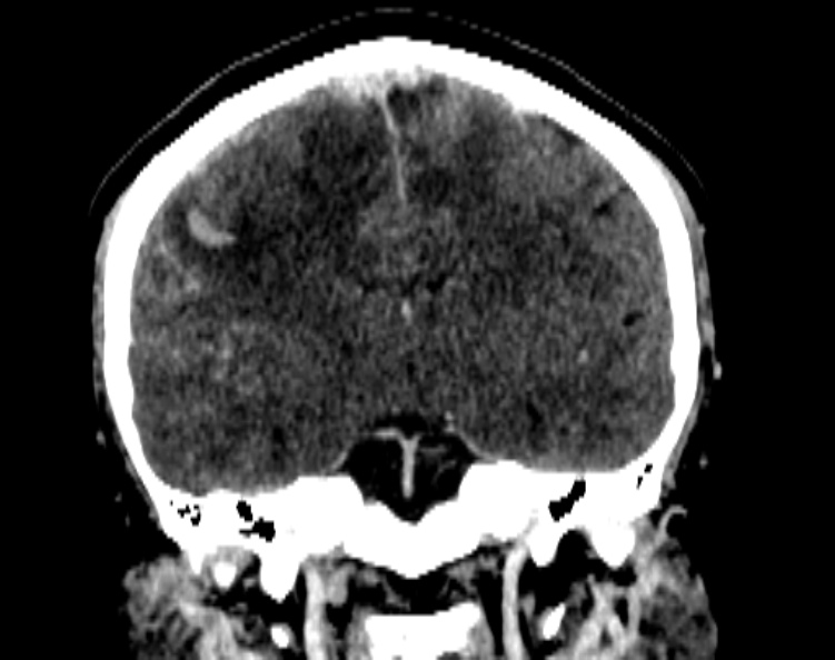 Cerebral venous hemorrhagic infarct from venous sinus thrombosis (Radiopaedia 55433-61883 Coronal C+ delayed 34).jpg