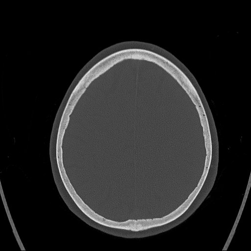 Cerebral venous infarction with hemorrhage (Radiopaedia 65343-74381 Axial bone window 144).jpg