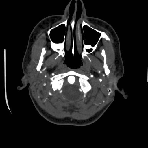 Cerebral venous sinus thrombosis (Radiopaedia 40619-43227 A 14).jpg