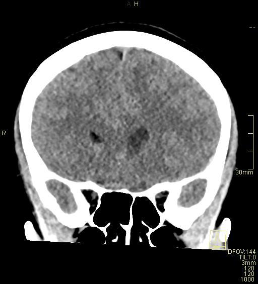 Cerebral venous sinus thrombosis (Radiopaedia 91329-108965 Coronal non-contrast 18).jpg