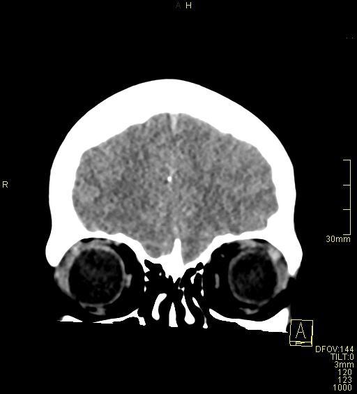 Cerebral venous sinus thrombosis (Radiopaedia 91329-108965 Coronal non-contrast 9).jpg