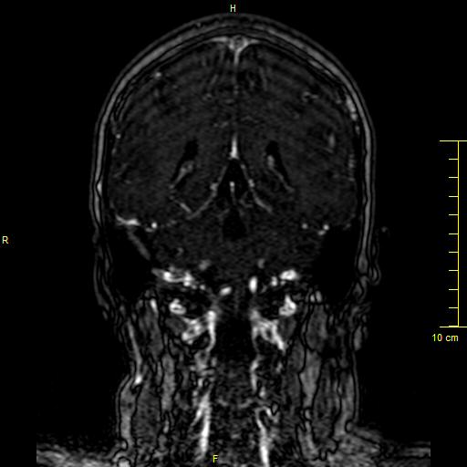 Cerebral venous thrombosis (Radiopaedia 23288-23351 MRV 107).JPG