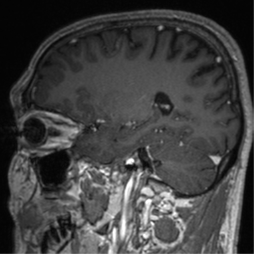 Cerebral venous thrombosis (Radiopaedia 38392-40469 Sagittal T1 C+ 59).png