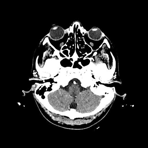 Cerebral venous thrombosis with venous hemorrhagic infarct (Radiopaedia 90354-107660 Axial with contrast 31).jpg