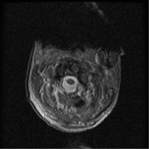 File:Cervical canal stenosis with cord compression (Radiopaedia 34114-35374 Axial Gradient Echo 89).png