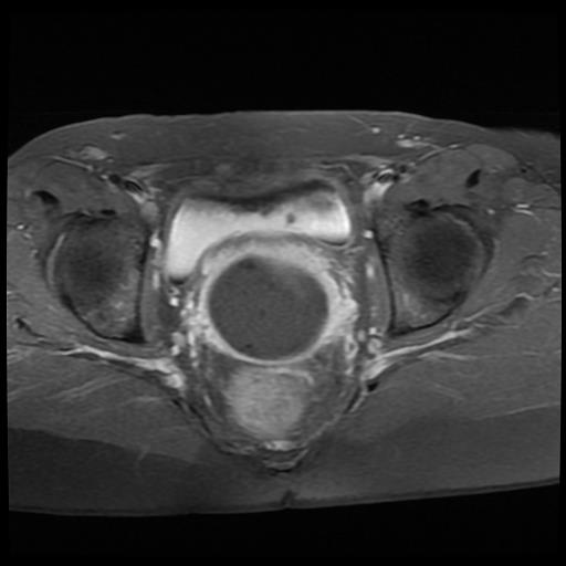 File:Cervical cancer (Radiopaedia 62991-71413 Axial T1 C+ fat sat 12).jpg