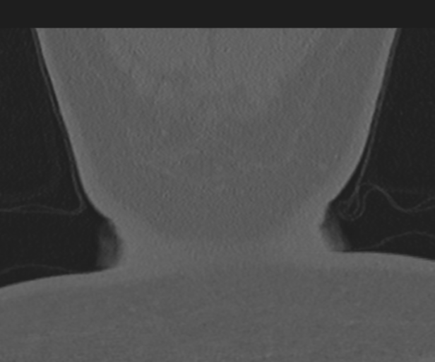Cervical disc replacement (Radiopaedia 44025-47541 Coronal bone window 62).png