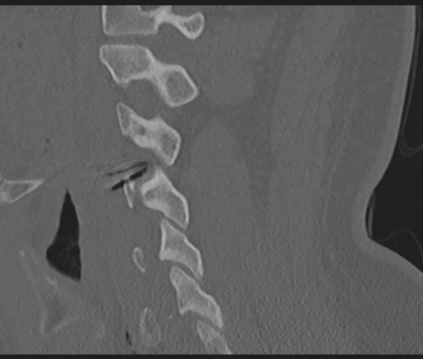 File:Cervical disc replacement (Radiopaedia 44025-47541 Sagittal bone window 53).png