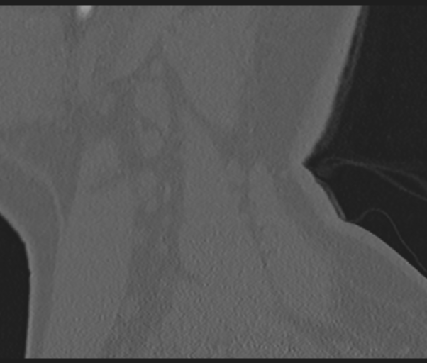 Cervical disc replacement (Radiopaedia 44025-47541 Sagittal bone window 8).png