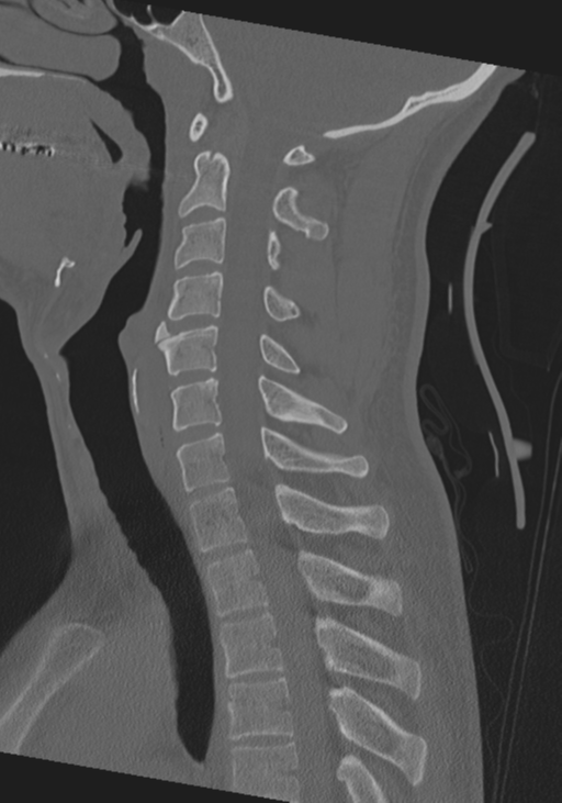 Cervical intercalary bone (Radiopaedia 35211-36748 Sagittal bone window 38).png