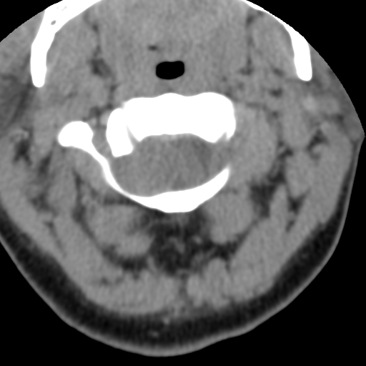 Cervical schwannoma (Radiopaedia 57979-64974 Axial non-contrast 17).png