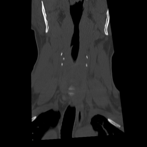 Cervical schwannoma (Radiopaedia 57979-64974 Coronal bone window 19).png