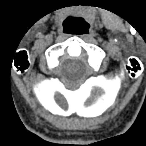 File:Cervical spinal neurofibroma in a patient with NF1 (Radiopaedia 58344-65464 Axial non-contrast 12).jpg