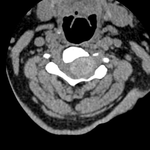 File:Cervical spinal neurofibroma in a patient with NF1 (Radiopaedia 58344-65464 Axial non-contrast 34).jpg