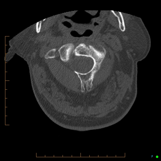 File:Cervical spine fracture - ankylosing spondylitis (Radiopaedia 76835-88706 Axial bone window 45).jpg