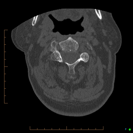 File:Cervical spine fracture - ankylosing spondylitis (Radiopaedia 76835-88706 Axial bone window 68).jpg
