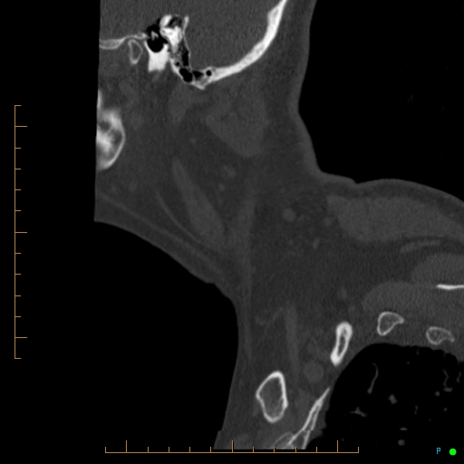 File:Cervical spine fracture - ankylosing spondylitis (Radiopaedia 76835-88706 Sagittal bone window 109).jpg