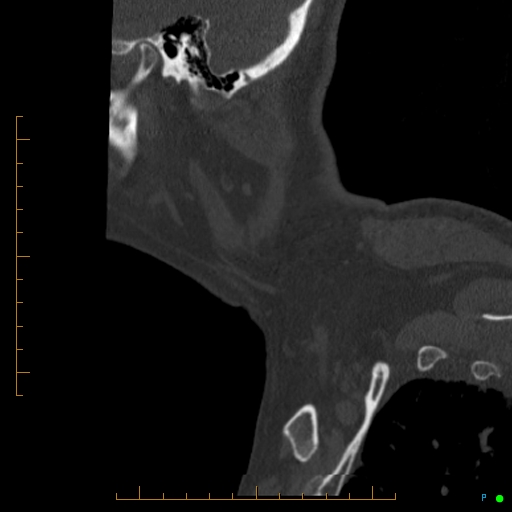 Cervical spine fracture - ankylosing spondylitis (Radiopaedia 76835-88706 Sagittal bone window 111).jpg