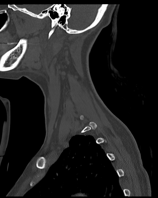 Cervical tuberculous spondylitis (Radiopaedia 39149-41365 Sagittal bone window 12).png
