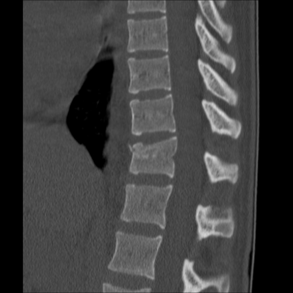 Chance fracture (Radiopaedia 36521-38081 Sagittal bone window 31).jpg