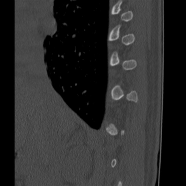 Chance fracture (Radiopaedia 36521-38081 Sagittal bone window 8).jpg