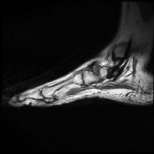 File:Charcot arthropathy (Radiopaedia 55056-61422 Sagittal T1 in-phase 4).jpg