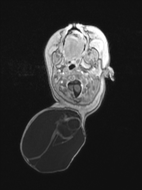 Chiari III malformation with occipital encephalocele (Radiopaedia 79446-92559 Axial T1 C+ mpr 28).jpg