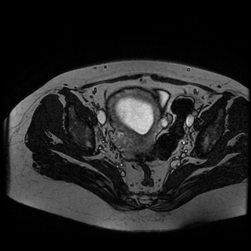 Chiari II malformation - fetal MRI (Radiopaedia 68099-77581 Axial Fiesta 53).jpg