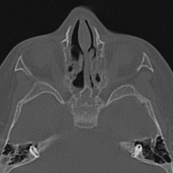 Choanal atresia (Radiopaedia 88525-105975 Axial bone window 55).jpg