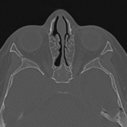 Choanal atresia (Radiopaedia 88525-105975 Axial bone window 68).jpg