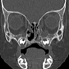 File:Choanal atresia (Radiopaedia 88525-105975 Coronal bone window 40).jpg