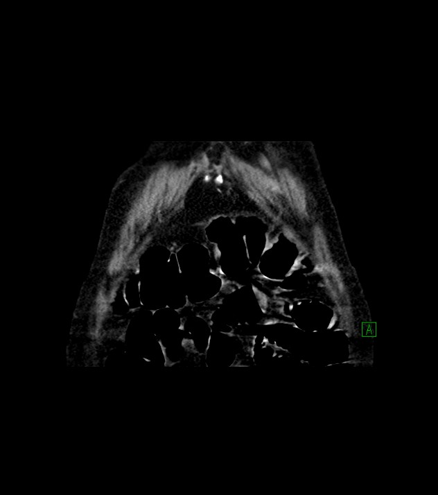 Cholangiocarcinoma with cerebral metastases (Radiopaedia 83519-98629 Coronal C+ delayed 7).jpg