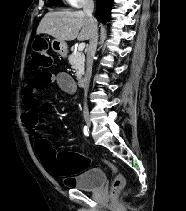 Cholangiocarcinoma with cerebral metastases (Radiopaedia 83519-98629 F 68).jpg