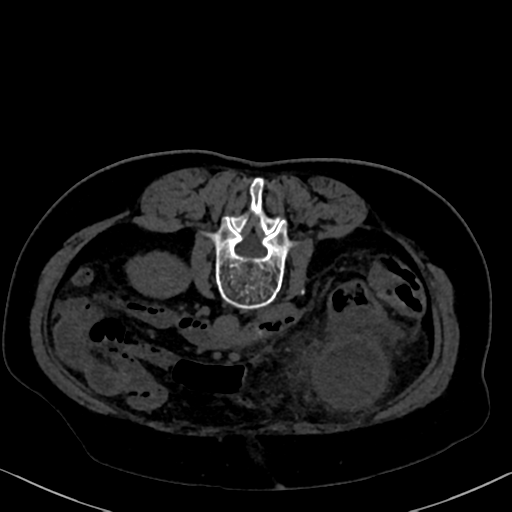 File:Cholecystitis - obstructive choledocholitiasis (CT intravenous cholangiography) (Radiopaedia 43966-47479 Axial 52).png