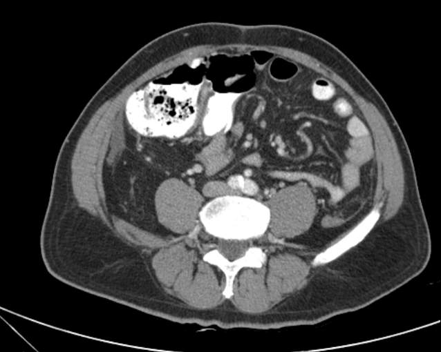 Cholecystitis - perforated gallbladder (Radiopaedia 57038-63916 A 53).jpg