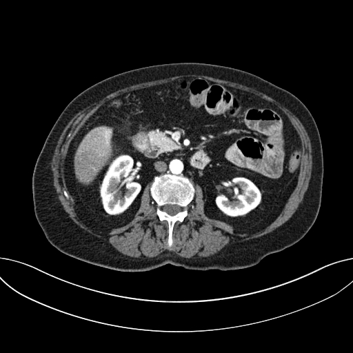 Cholecystoduodenal fistula due to calculous cholecystitis with gallstone migration (Radiopaedia 86875-103077 A 32).jpg
