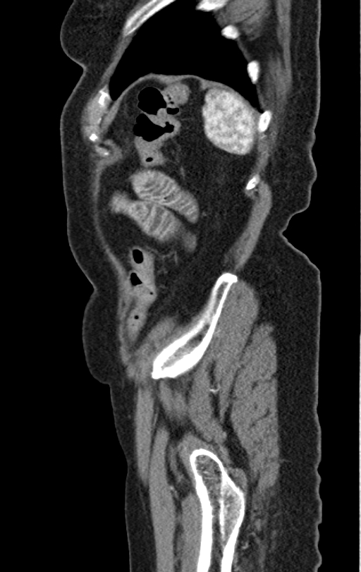 Cholecystoduodenal fistula due to calculous cholecystitis with gallstone migration (Radiopaedia 86875-103077 C 7).jpg