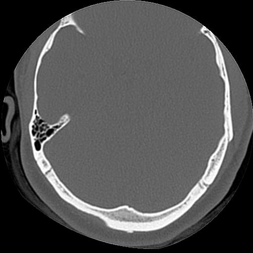 Cholesteatoma (Radiopaedia 84960-100474 Axial bone window 23).jpg