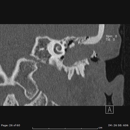 File:Cholesteatoma - external auditory canal (Radiopaedia 88452-105096 Coronal bone window 26).jpg
