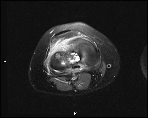 File:Chondroblastoma (Radiopaedia 62721-71031 Axial PD fat sat 20).jpg