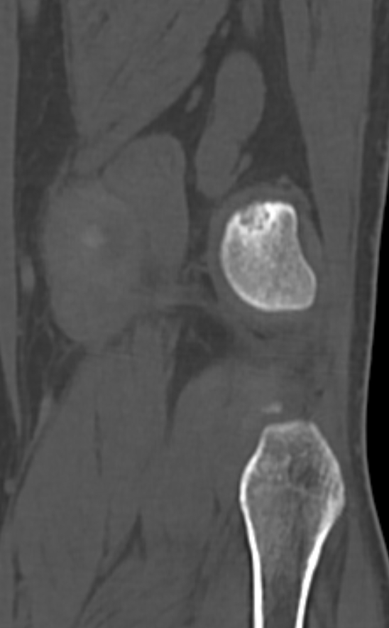 Chondrocalcinosis (Radiopaedia 82862-97173 Coronal bone window 66).jpg