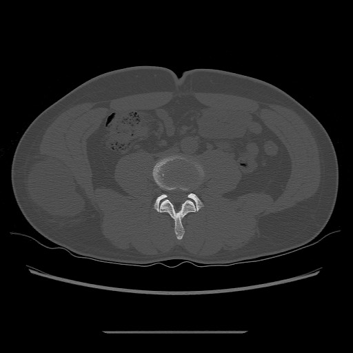 File:Chondrosarcoma of iliac wing (Radiopaedia 63861-72599 Axial bone window 15).jpg