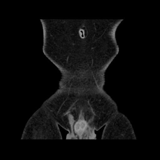 Chondrosarcoma of iliac wing (Radiopaedia 63861-72599 Coronal non-contrast 17).jpg