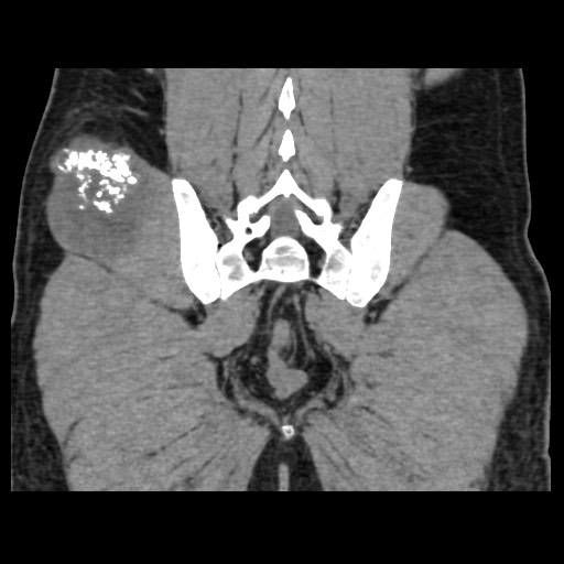 File:Chondrosarcoma of iliac wing (Radiopaedia 63861-72599 Coronal non-contrast 89).jpg