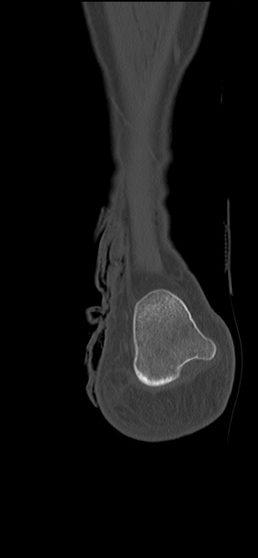 Chopart fracture (Radiopaedia 35347-36851 Coronal bone window 9).jpg