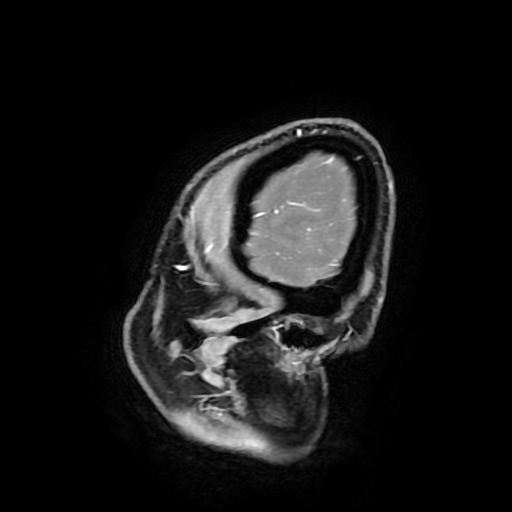 Chordoid glioma of third ventricle (Radiopaedia 91612-109340 F 27).jpg