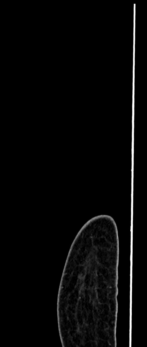 Choriocarcinoma liver metastases (Radiopaedia 74768-85766 C 18).jpg