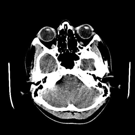 File:Choriocarcinoma of ovary with cerebral and pulmonary metastases (Radiopaedia 25983-26118 C+ arterial phase 24).jpg
